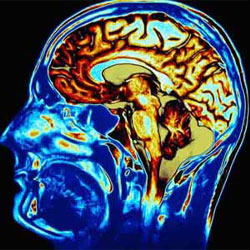 افزایش خطر ابتلا به بیش‌ فعالی‌ با آسیب ضربه مغزی 
